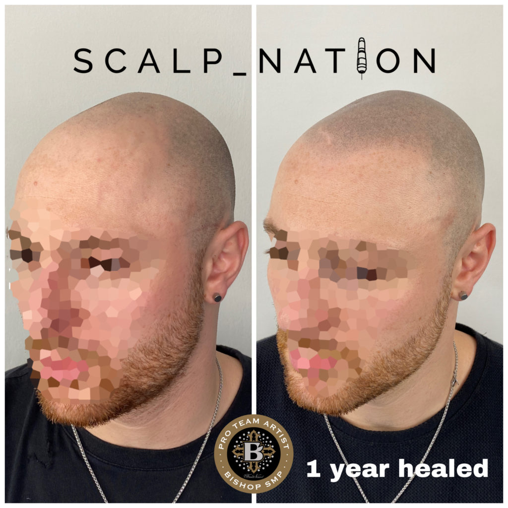 HM3 scalp pigmentation healed 1024x1024 1