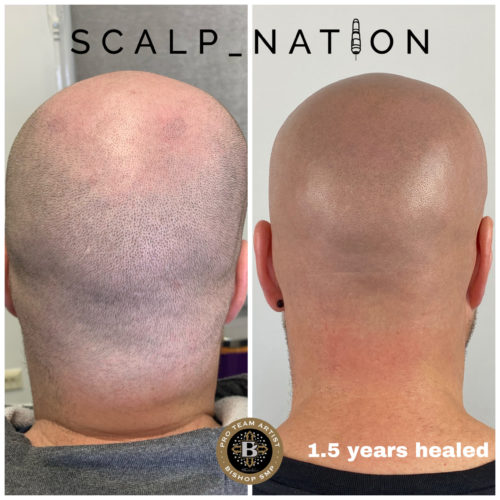 PM1 scalp pigmentation healed scaled e1659356790454