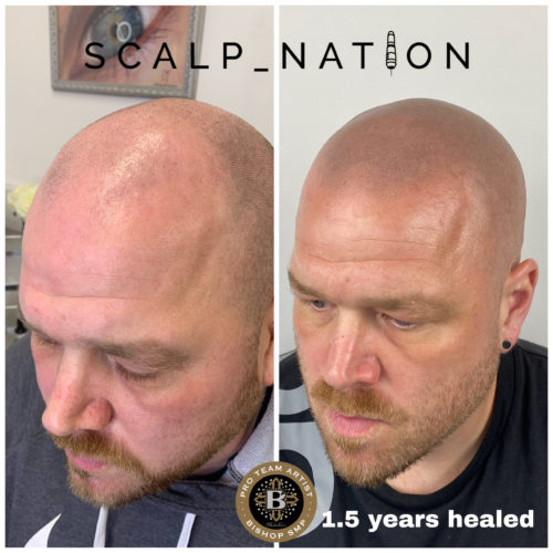 PM2 scalp pigmentation healed scaled e1659356828961