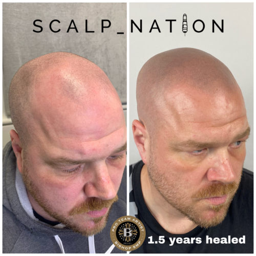 PM3 scalp pigmentation healed scaled e1659356760421