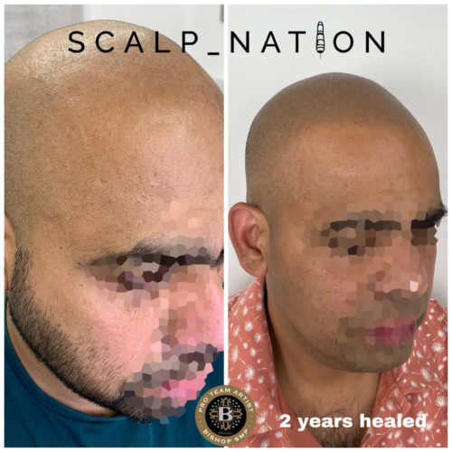 TK1 scalp pigmentation healed scaled e1659356692318