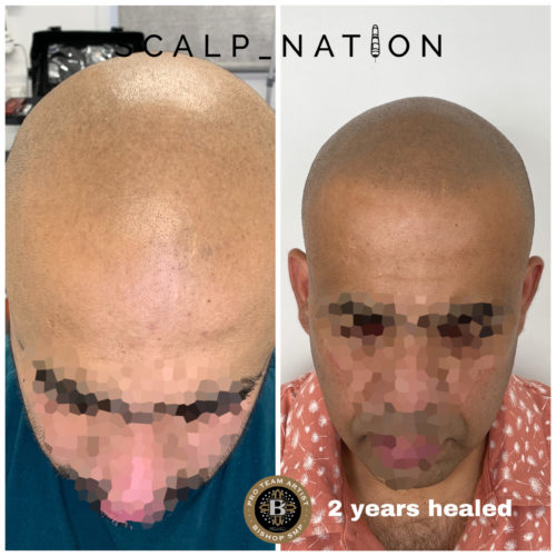 TK2 scalp pigmentation healed scaled e1659356716869