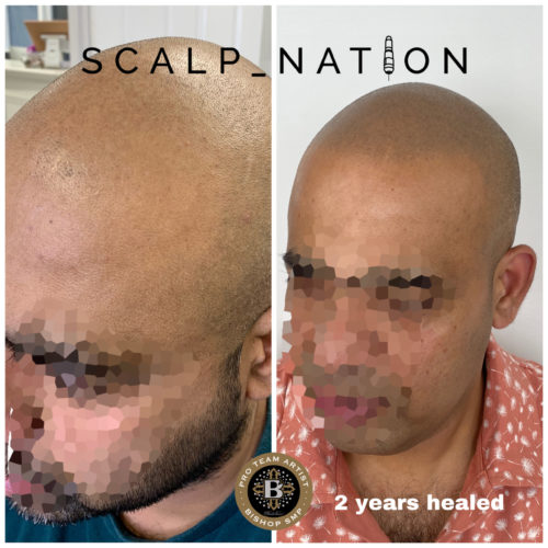 TK3 scalp pigmentation healed scaled e1659356734214