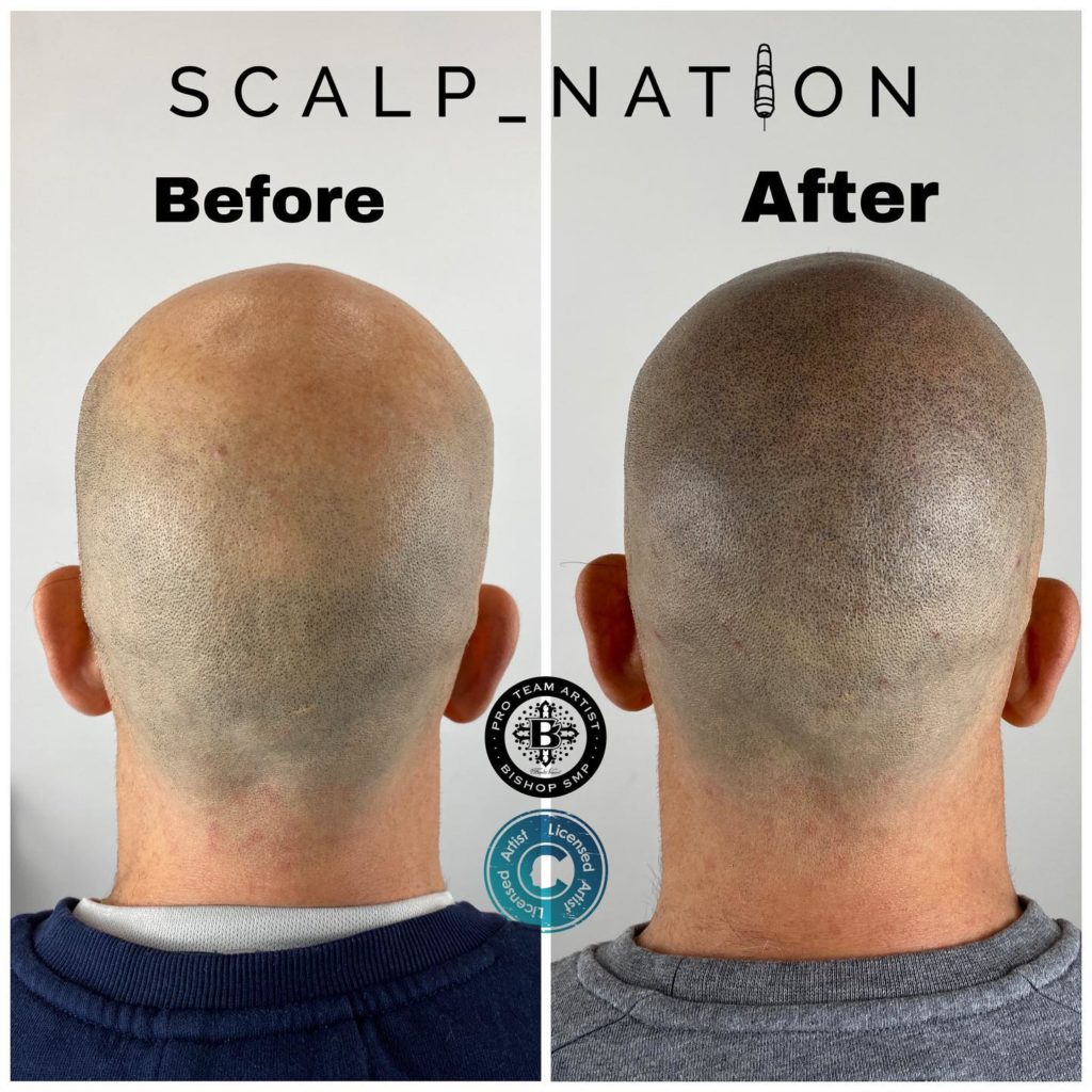 Traction Alopecia Hairline Thinning and Regrowth Options 1 Results of scalp micropigmentation for alopecia