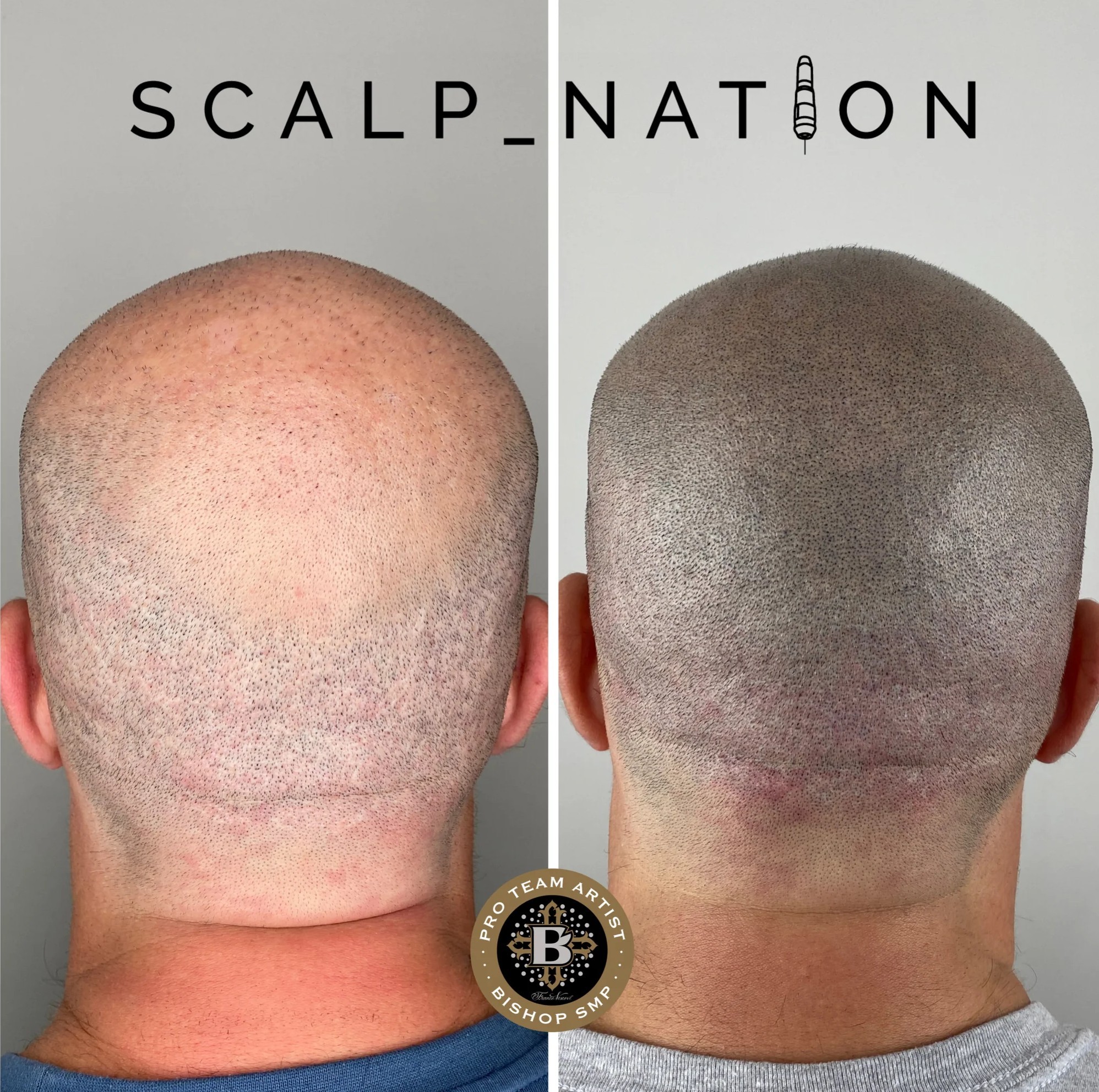 ADS smp after hair transplant 3