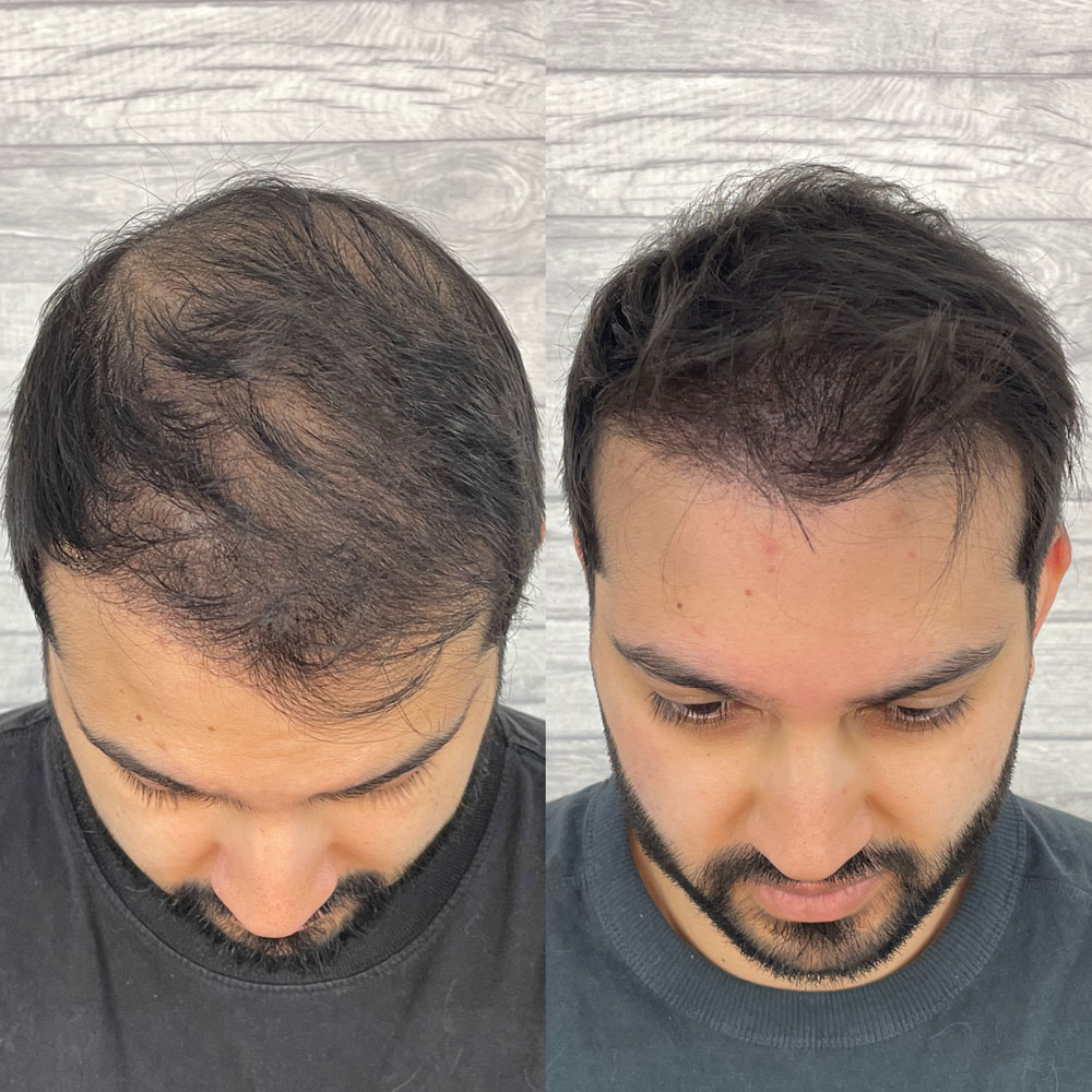 Landing Page 28 hair density