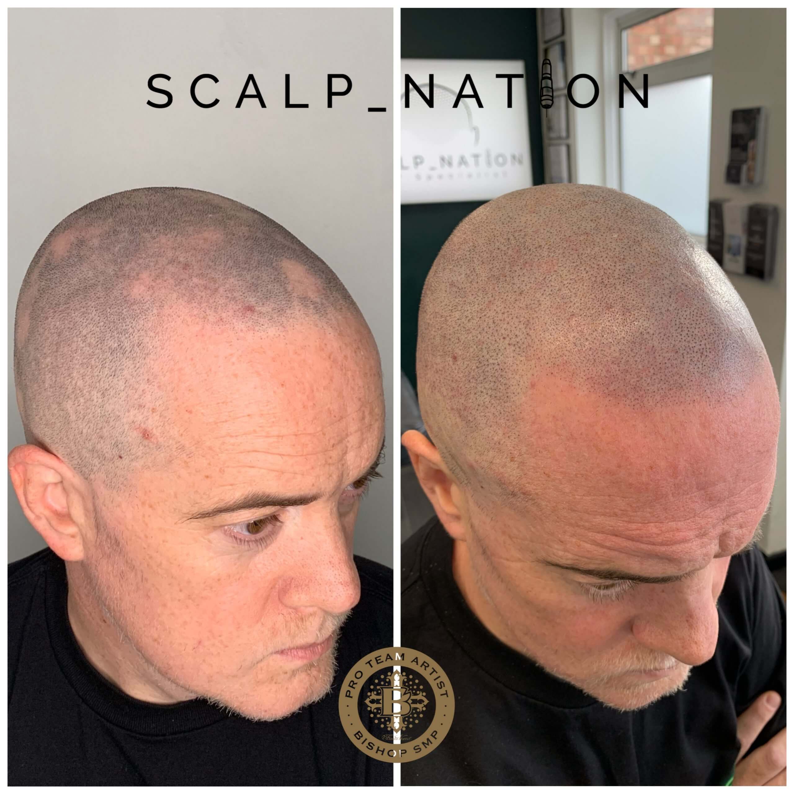 Landing Page 21 scalp-micro-pigmentation-for-alopecia-before-scaled-1.jpeg