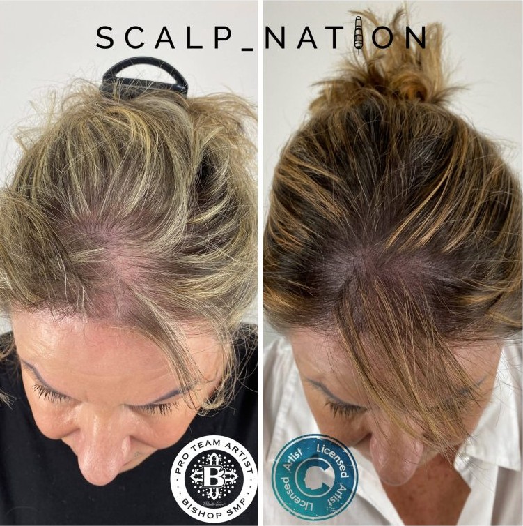 scalp micro pigmentation for women before and after scaled min 768x768 1