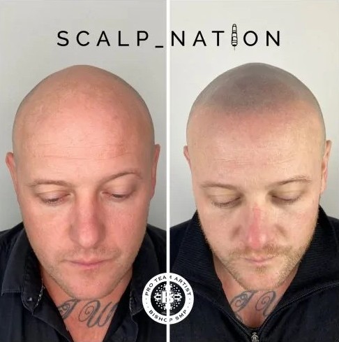 scalp micro pigmentation results scaled e1652087238963