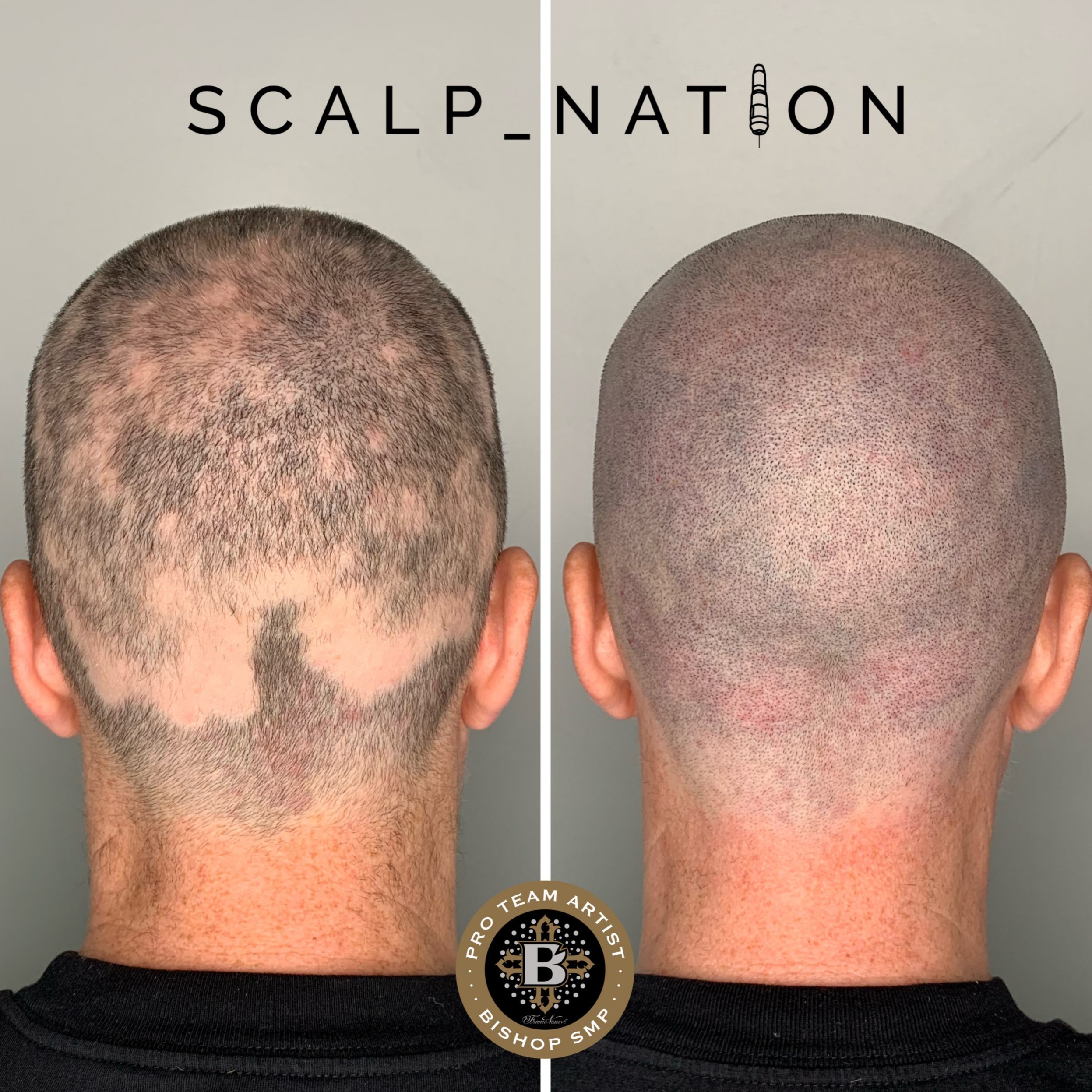 scalp micropigmentation for alopecia after scaled 1