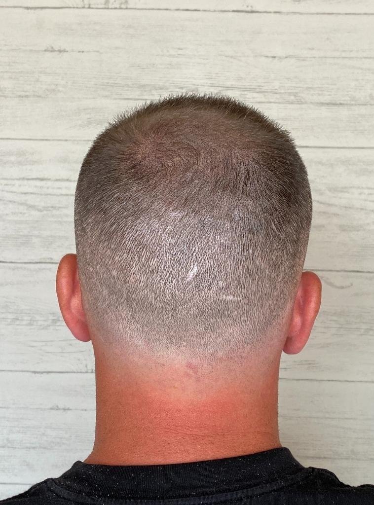 scalp micropigmentation for long hair
