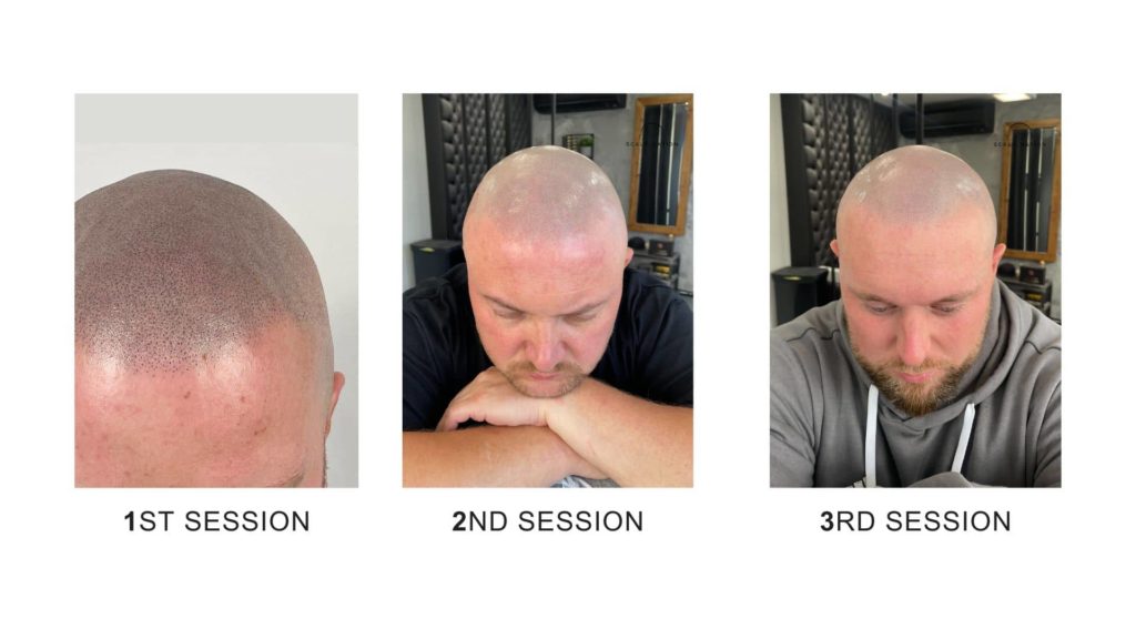 What to Expect From Scalp Micropigmentation Before and After 1 Scalp micropigmentation before and after