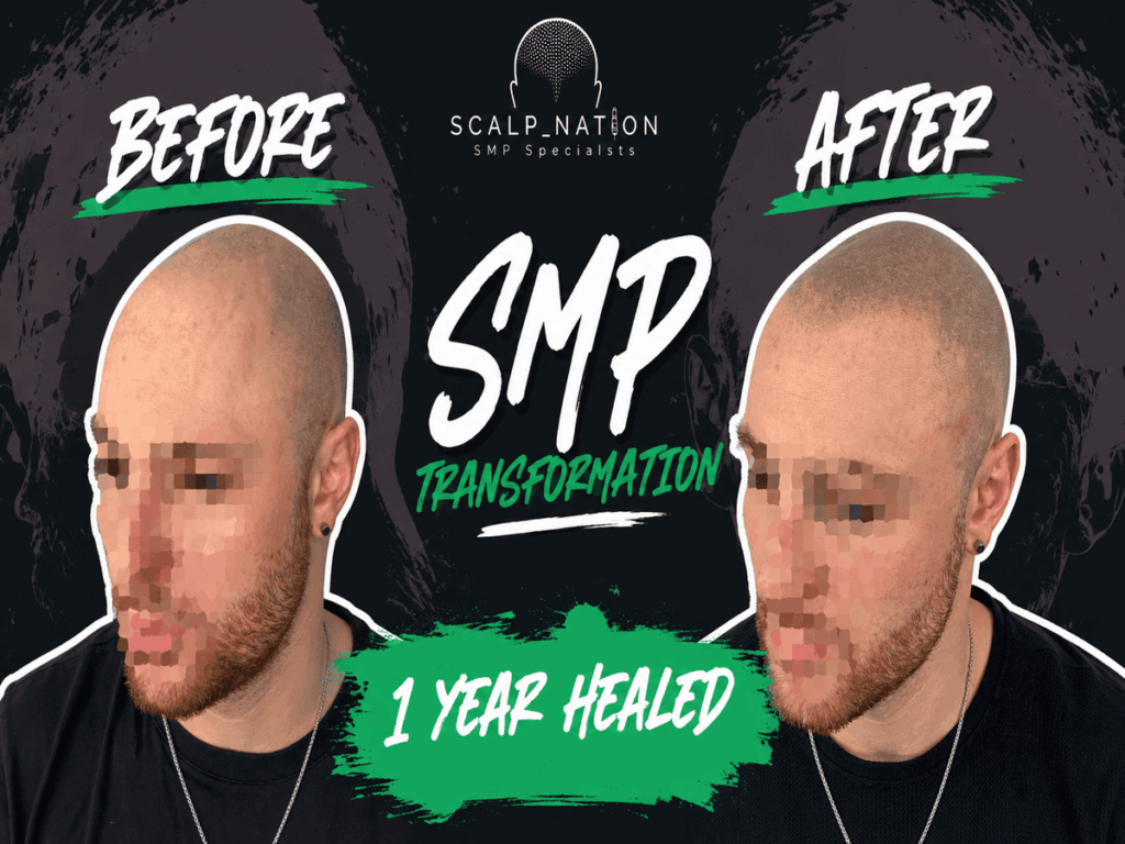 1 year healed SMP result