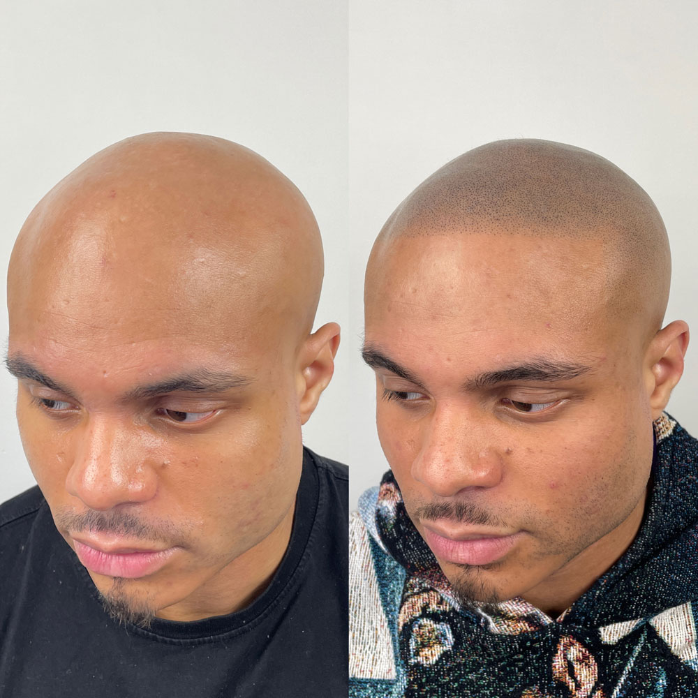 Home 23 Alopecia
