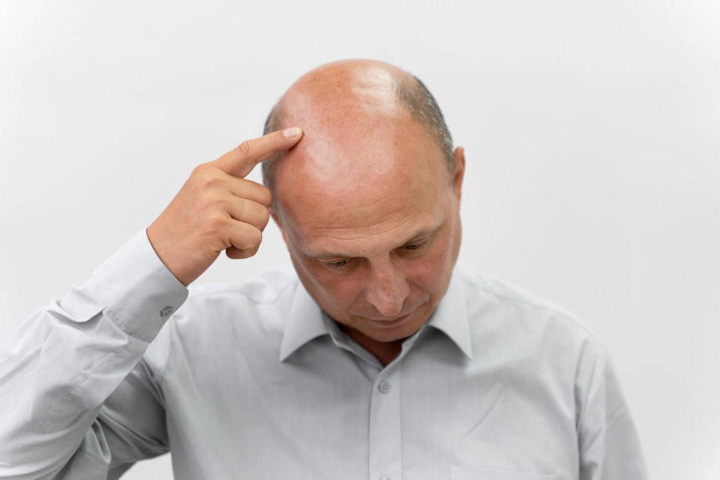 Androgenetic Alopecia Early Signs