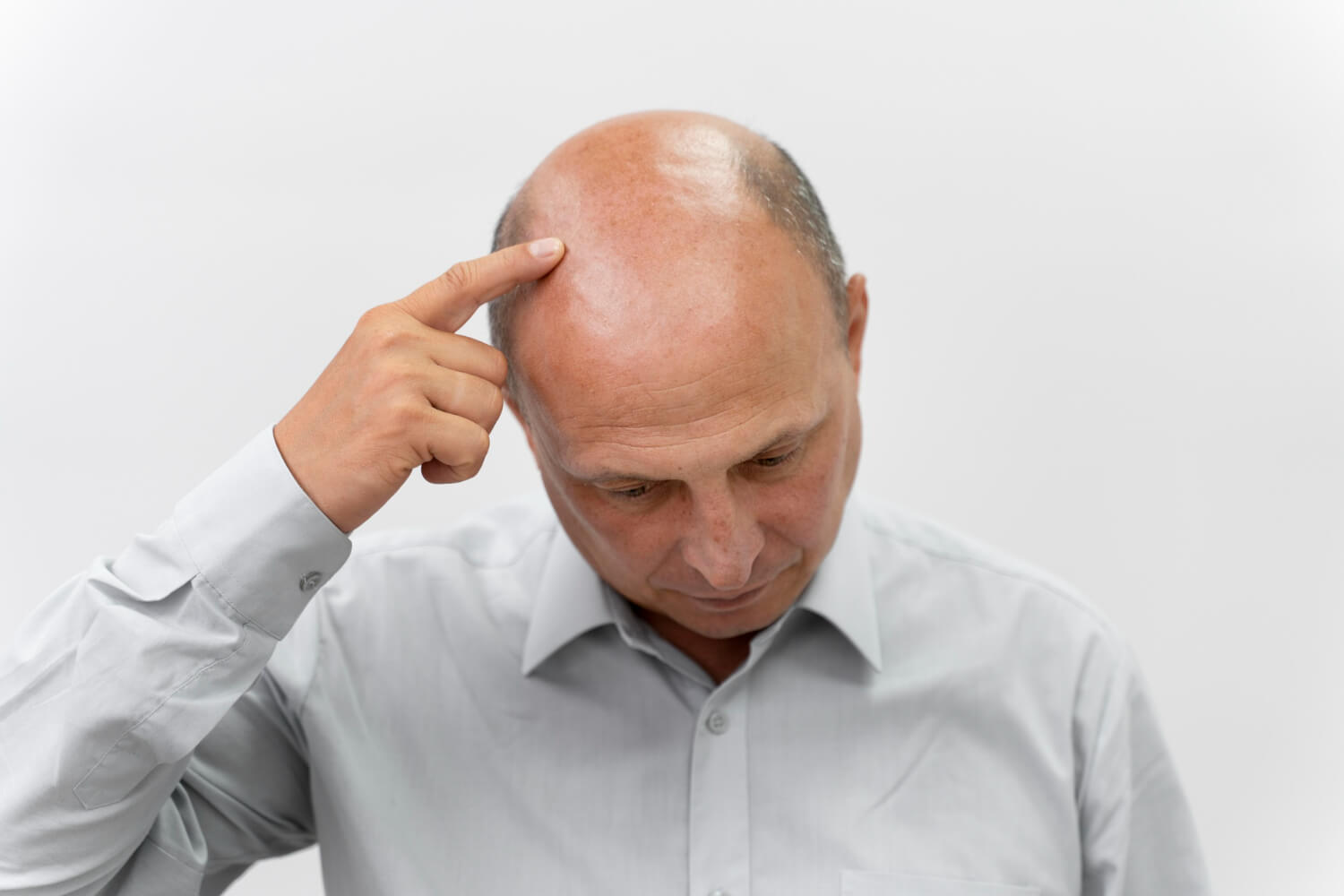 Androgenetic Alopecia Early Signs