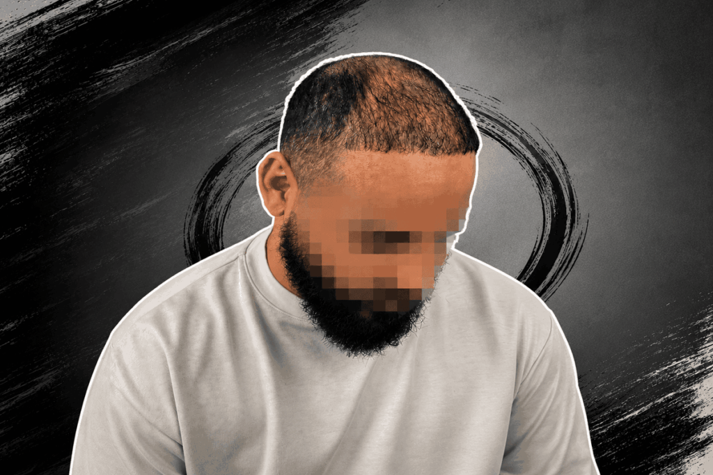 Afro Caribbean Hair Loss Treatment: A Trichologist's Complete Guide 2026 1 Alt text: Man with thinning hair considering scalp micropigmentation treatment