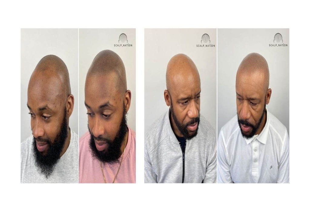 SMP before and after results on black men