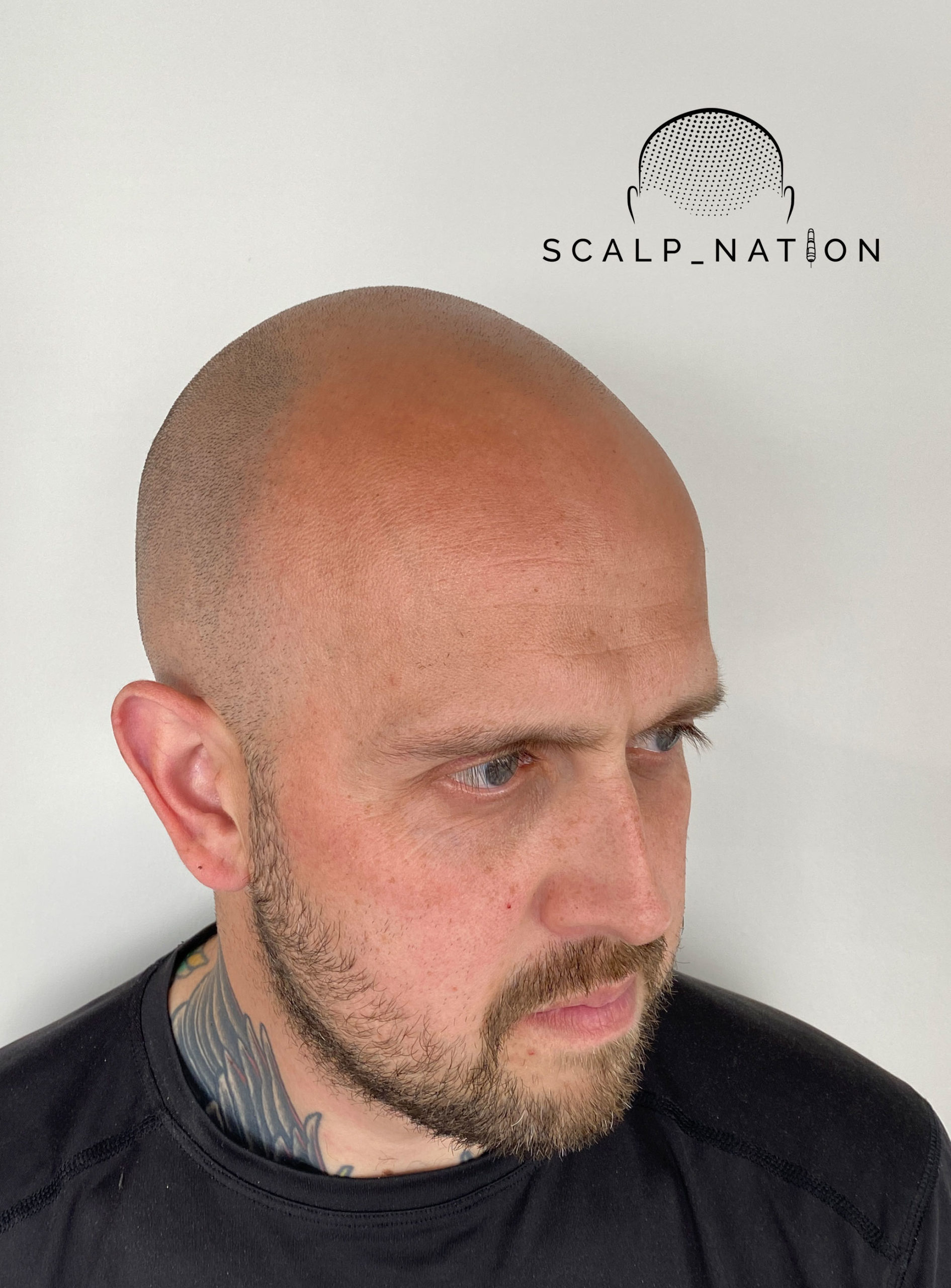 What Age Do Men Start Balding and How to Spot the First Signs 1 The First Signs Of Balding